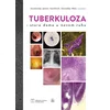 Tuberkuloza- stara dama u novom ruhu